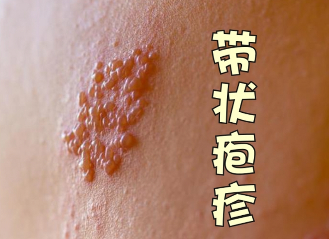 带状疱疹655 带状疱疹655