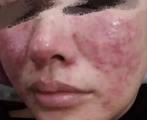 玫瑰痤疮2 玫瑰痤疮2