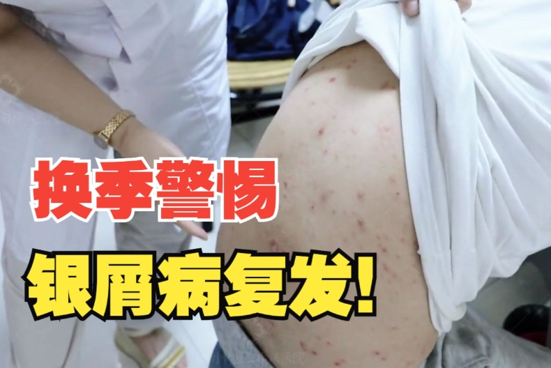 银屑病5656 银屑病5656