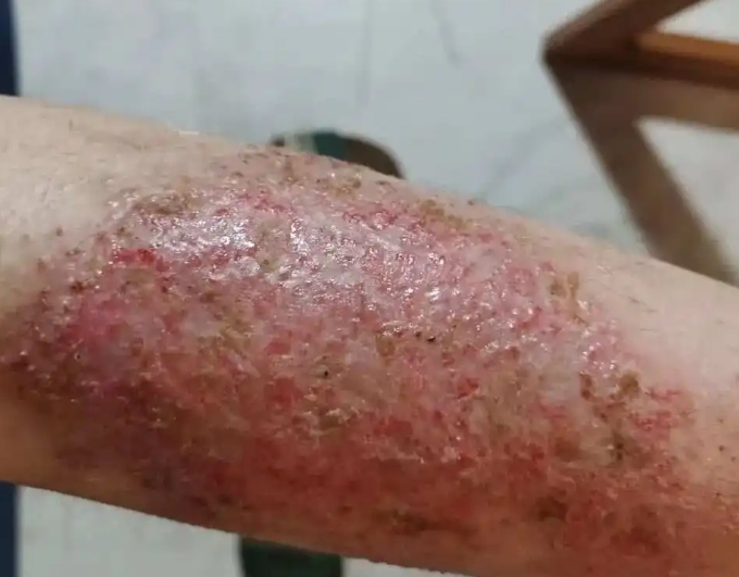 湿疹595 湿疹595