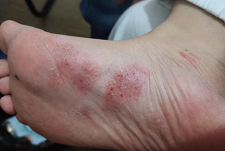 湿疹足部45 湿疹足部45