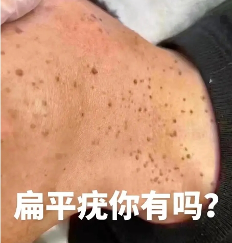 扁平疣563 扁平疣563