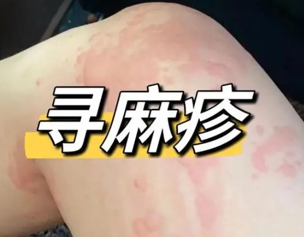 荨麻疹31 荨麻疹31