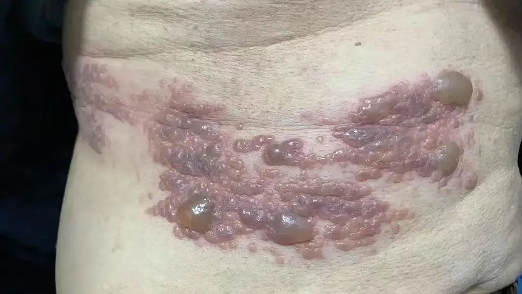 带状疱疹355
